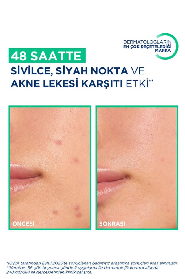 Sebium Kerato+ Sivilce, Akne Lekesi Karşıtı AHA, BHA, Salisilik Asit İçeren Bakım Kremi 30 ml